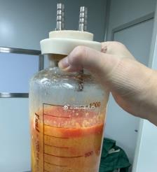 荣成水动力吸脂手术要做多久？